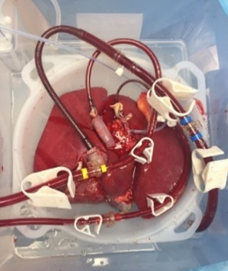 liver for transplant in a normothermic perfusion device