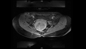 FIGURE 1a. Example MRI at screening, 7-cm diameter uterine fibroid.