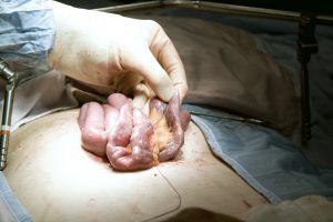 Gastric bypass surgery. Surgeon holding intestines that are being reconstructed to reduce the amount of food absorbed by the patient. This surgery also reduces the size of the stomach, which will make the patient feel full after eating less food.