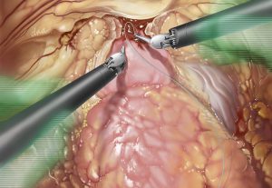Robotic Assisted Prostatectomy