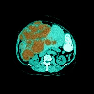 This color enhanced axial (cross sectional) CT, through the upper abdomen with oral contrast, shows extensive cysts (brown) within the liver which is enlarged. You can see the enlarged liver bulging towards the anterior abdominal wall. This condition is often autosomal dominant in inheritance and is often associated with cystic disease of the kidneys. The incidence of cystic change increases with age. Development of symptoms may be due to the associated mass effect on surrounding structures or associations with other abnormalities.