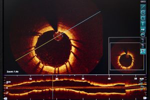 Coronary OCT (Optical Coherence Tomography) showing an artery fitted with a stent. Cardiology department of Saint-Philibert hospital (GHICL), Lille, France.
