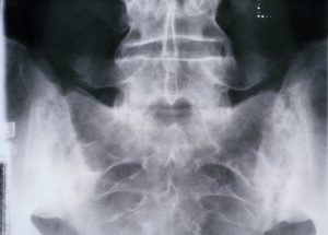 X-ray of the pelvis showing sacroiliitis resulting from ankylosing spondylitis.