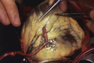 Coronary artery bypass graft.  Distal anastomosis of vein to coronary artery.