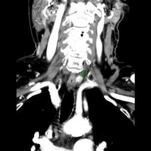 FIGURE. Four-dimensional computed tomography of the candidate parathyroid lesion prior to parathyroidectomy to determine its location. The lesion was posterior to the left thyroid lobe in the paraesophageal location and measured 13 mm