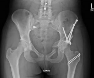 FIGURE 2. Postoperative radiography of the anteroposterior pelvis demonstrating improvement in the patient