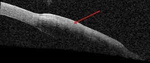 FIGURE 2. Anterior segment optical coherence tomography reveals a thickened, hyper-reflective epithelium (red arrow)
