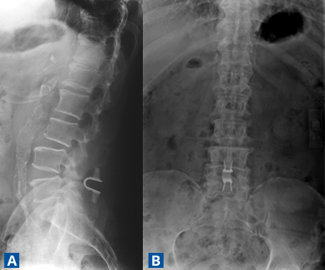 FIGURE 2A–B. (A) Lateral and (B) anteroposterior x-rays of the stabilization device