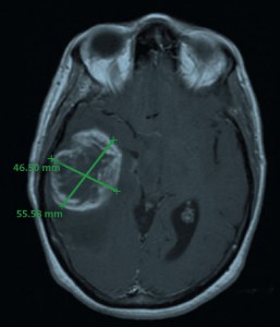 MRI image of the tumor in April 2006; measured dimensions 46.5 x 55.6 mm.