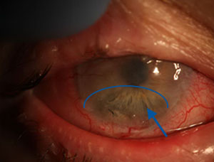FIGURE 3. Three weeks postoperative, the transplanted stem cells begin to enter patient’s center of vision in here right eye. Blue arrow and half-oval indicate the clearing area