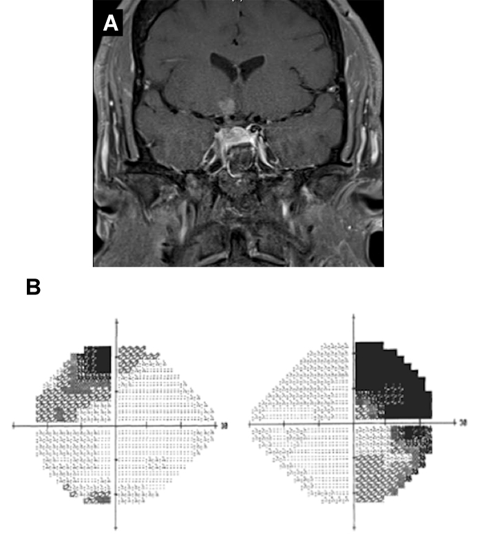 FIGURE 2: A) MRI demonstrating that optic chiasm has been elevated; B) Patient’s visual field following surgery