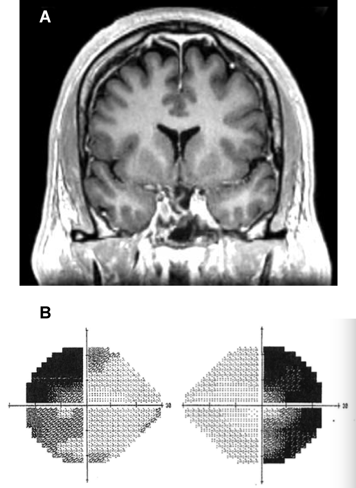  FIGURE 1: A) MRI revealing herniation of optic chiasm; B) Patient’s visual field