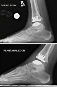Figure 2. Radiographs of ankle arthroplasty at 1-year follow-up, demonstrating preserved range of motion
