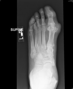 Dorsoplantar radiograph of left foot 