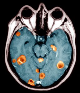 Secondary brain cancers, MRI