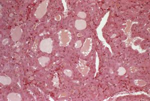 Thyroid tumour. Light micrograph of a section through tissue from a Hurthle cell adenoma. This is a rare type of thyroid tumour with a particular type of cell called Hurthle cells. This tumour is often highly malignant, spreading to bones and the lungs. The thyroid gland secretes the hormone thyroxine that controls the body