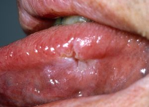 Spike-in-Syphilis-Incidence-Demands-Physician-Awareness