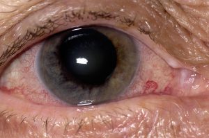 Treating-Glaucoma-in-a-Patient-With-Nanophthalmo